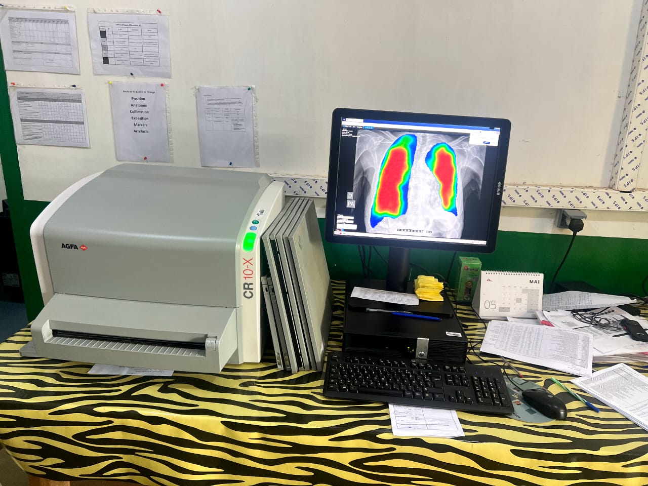Santé : Loin de Bangui, l’IA aide à dépister la tuberculose rca santé